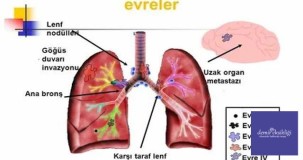 Akciğer Kanseri: Belirtileri, Tedavisi ve Evreleri